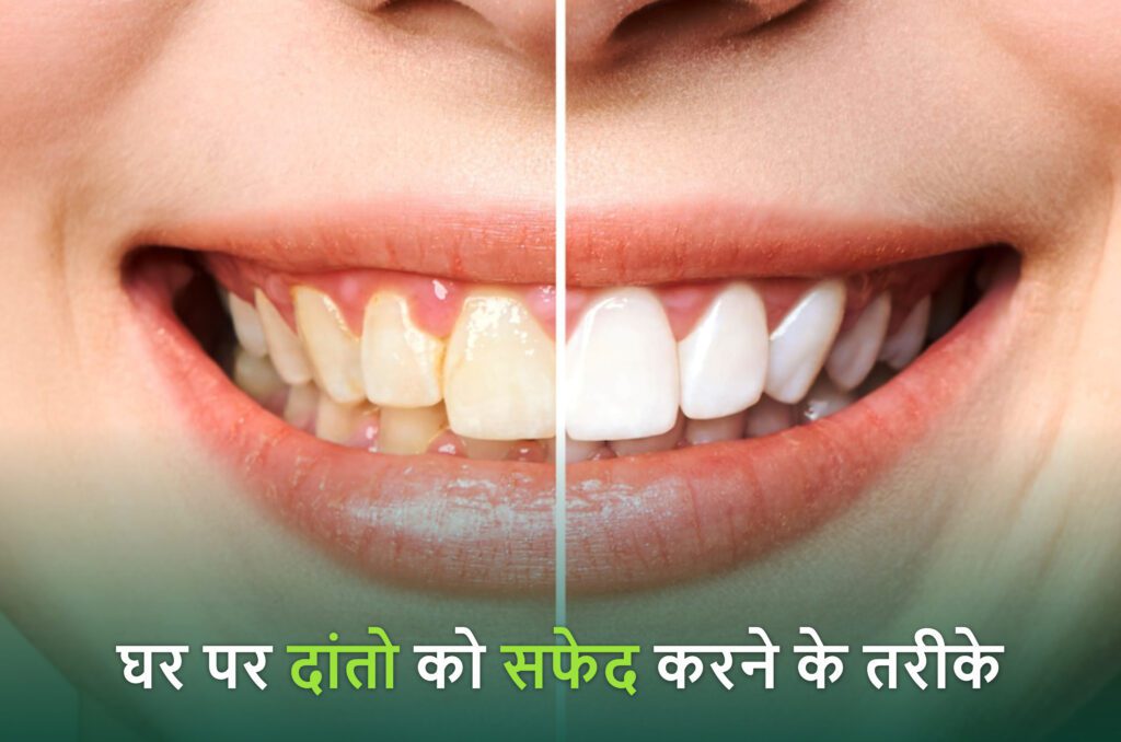 teeth whitening at home in hindi