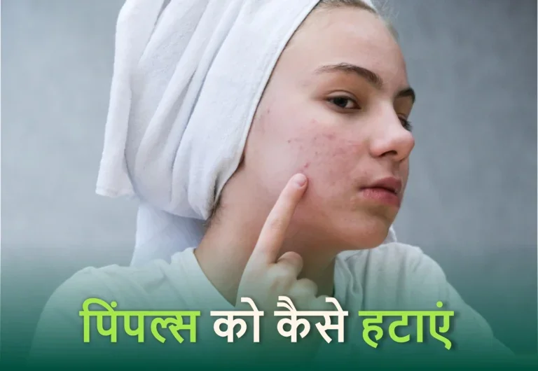 Remove Pimples Naturally and Permanently at home