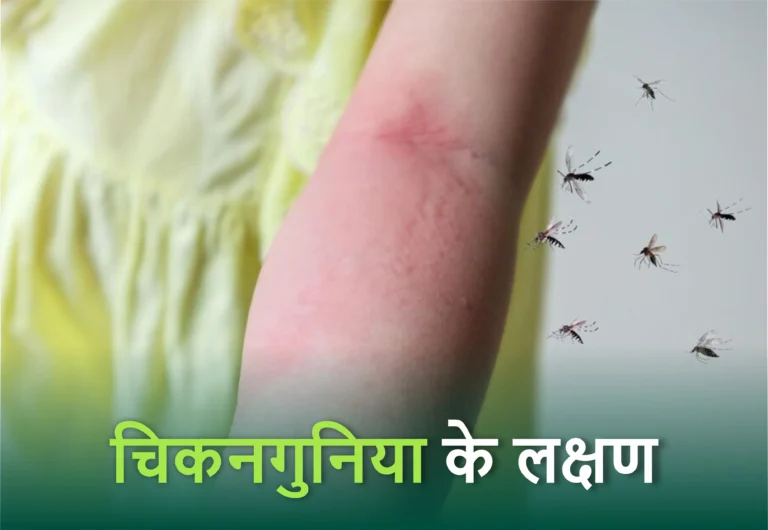 Chikungunya Symptoms & Treatment in Hindi