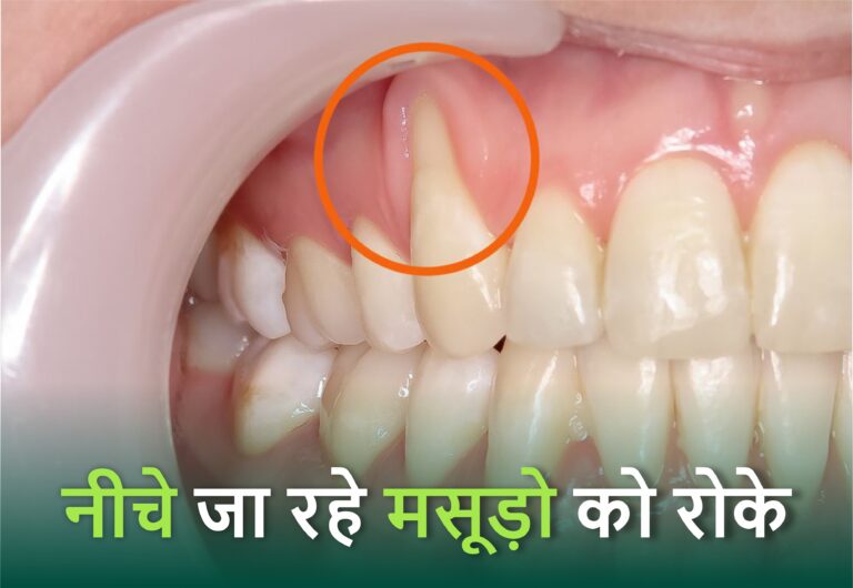How to Gum Recession Treatment in Hindi